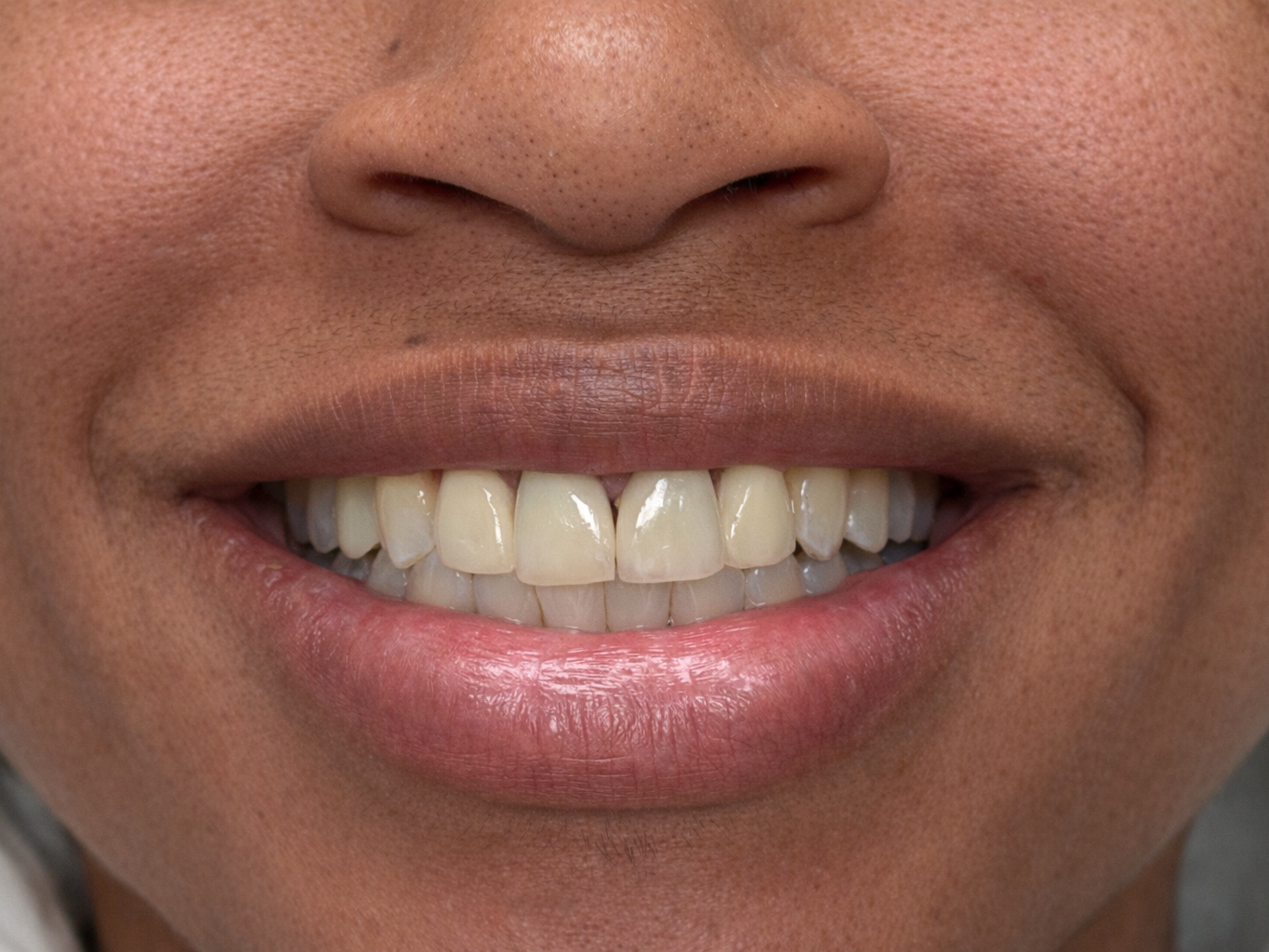 After veneers treatment