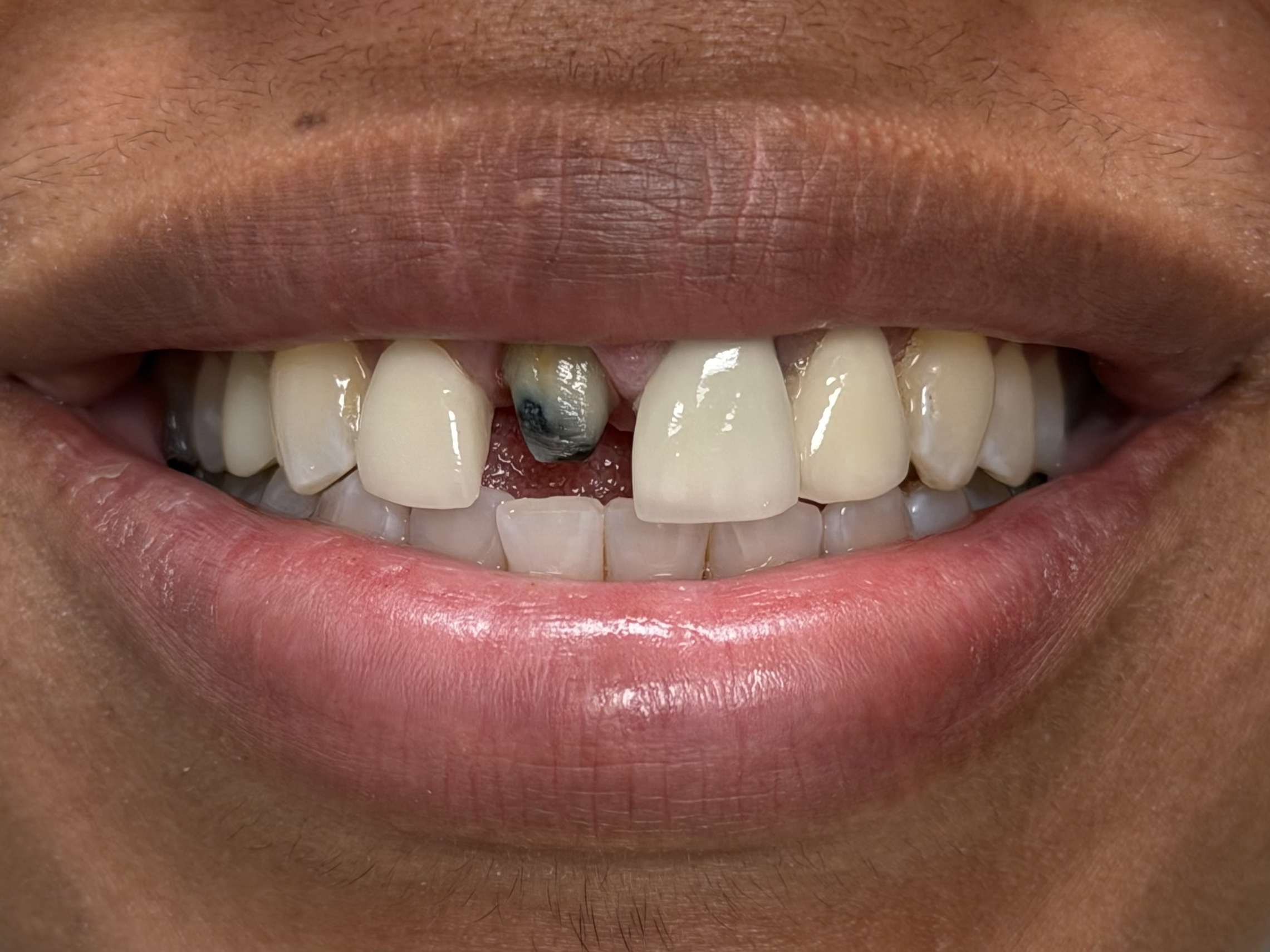 Before veneers treatment