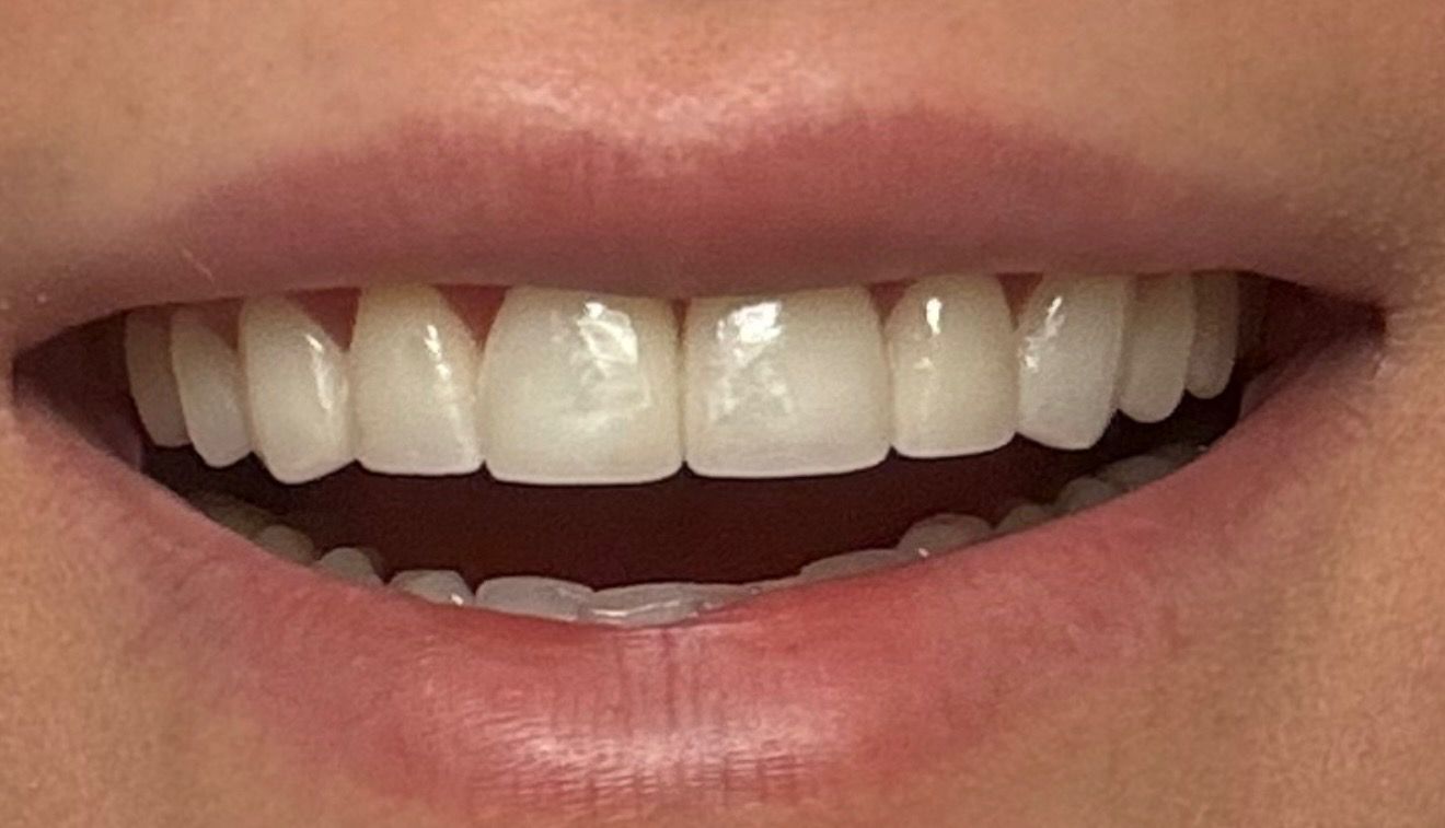 Perfect smile with porcelain veneers