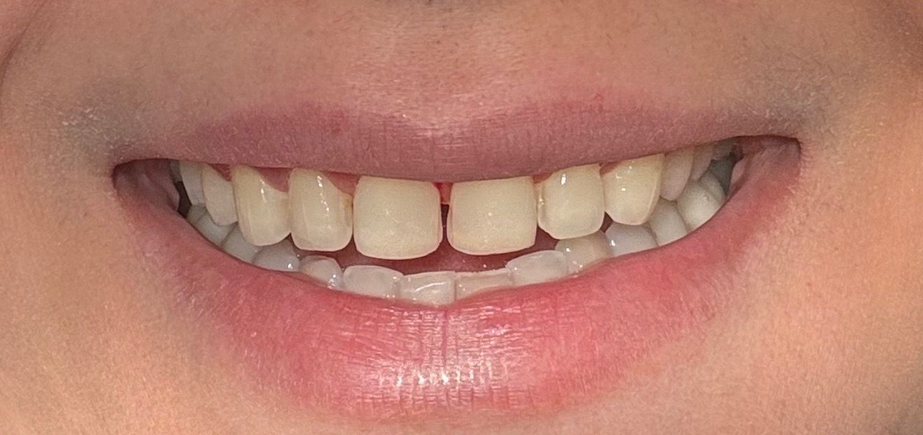 Natural teeth with cosmetic concerns