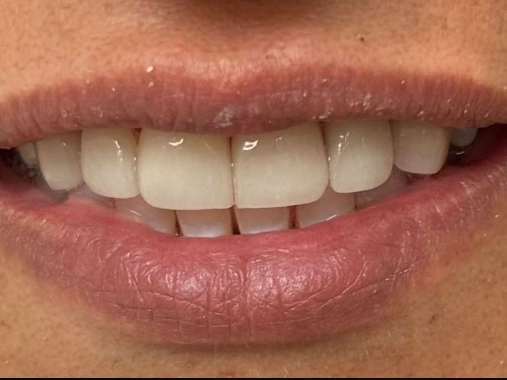 After smile transformation