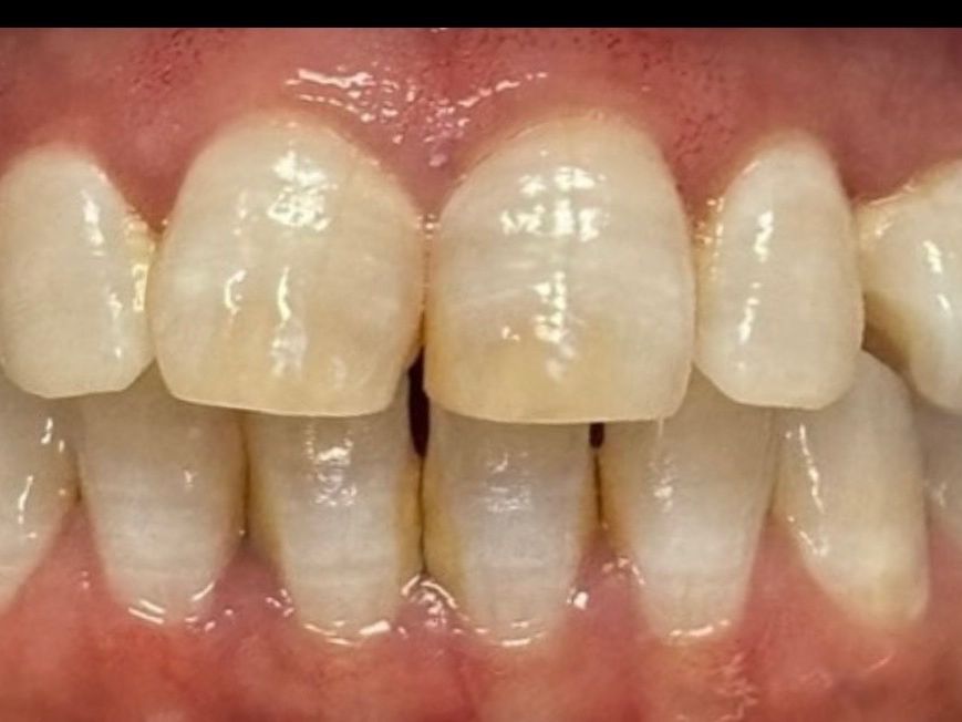 Before smile transformation