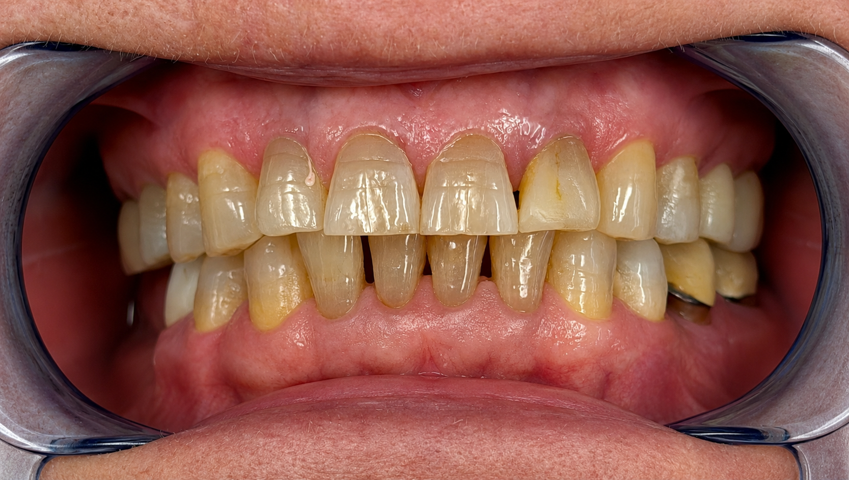 Before treatment