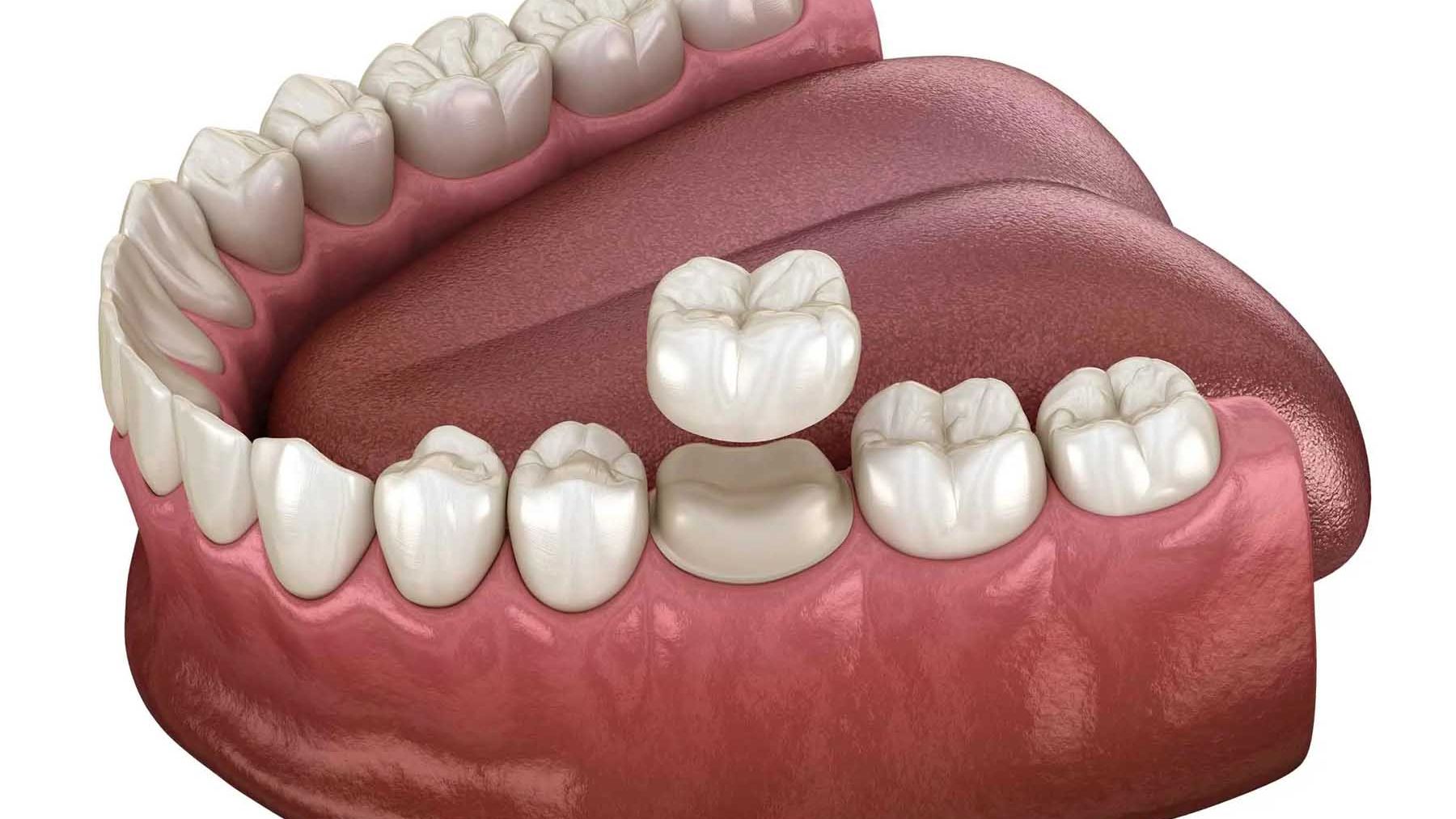 Final crown placement