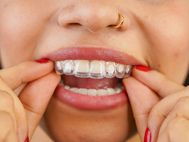 Clear aligner process at Lux Dentistry in Alpharetta, GA