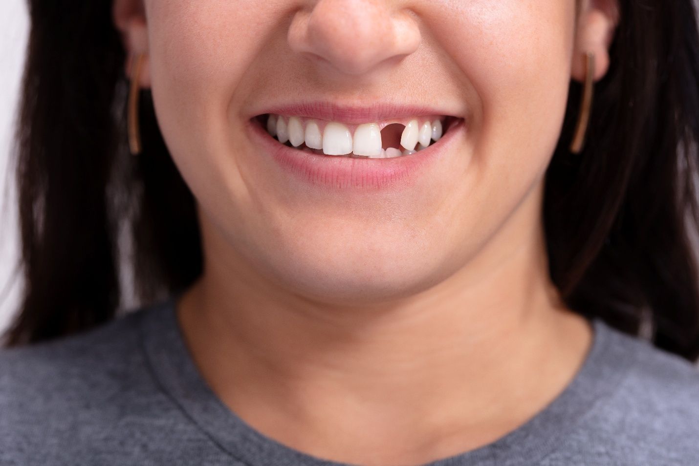 A woman with a missing tooth near Milton
