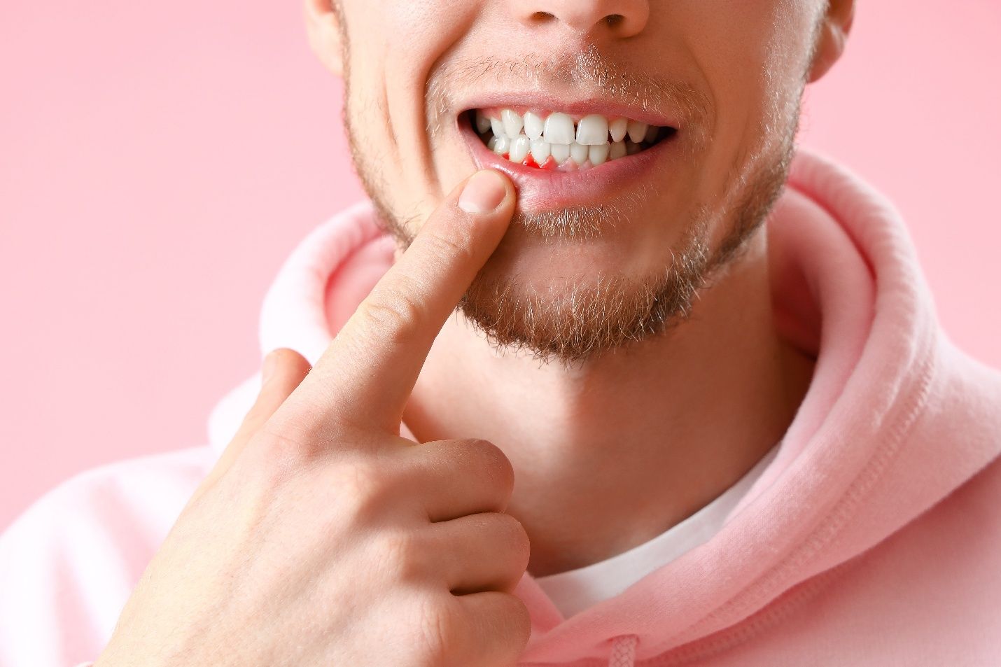 A man with bleeding gums near Milton