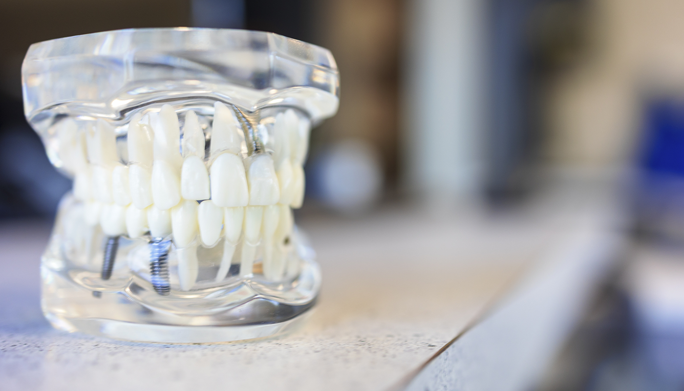Missing teeth replacement options at Lux Dentistry Alpharetta