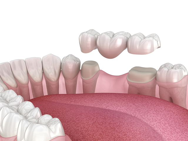 Dental bridges at Lux Dentistry Alpharetta