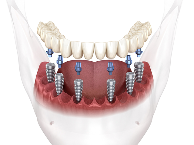Dental implants at Lux Dentistry Alpharetta