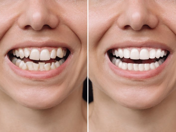 Say Goodbye to Imperfections: 3 Reasons to Get Veneers