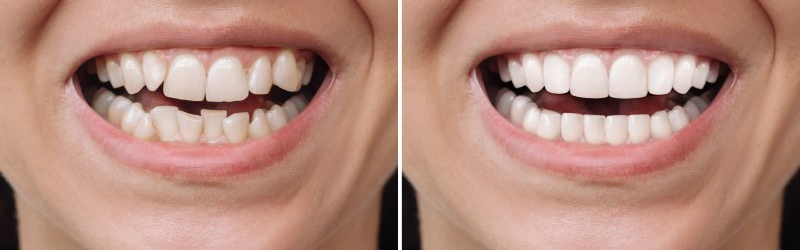 Say Goodbye to Imperfections: 3 Reasons to Get Veneers