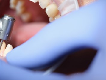 Exposed Enamel: How Much Must Be Removed to Receive Veneers?