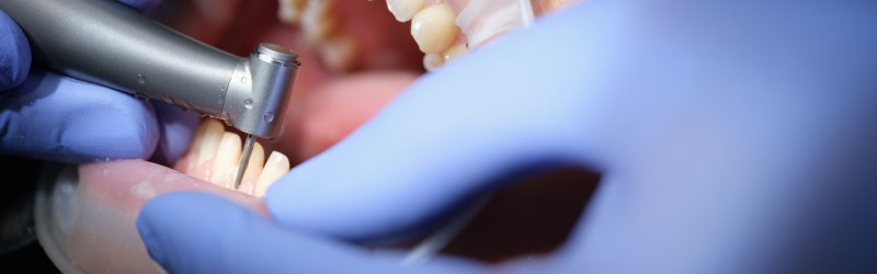 Exposed Enamel: How Much Must Be Removed to Receive Veneers?
