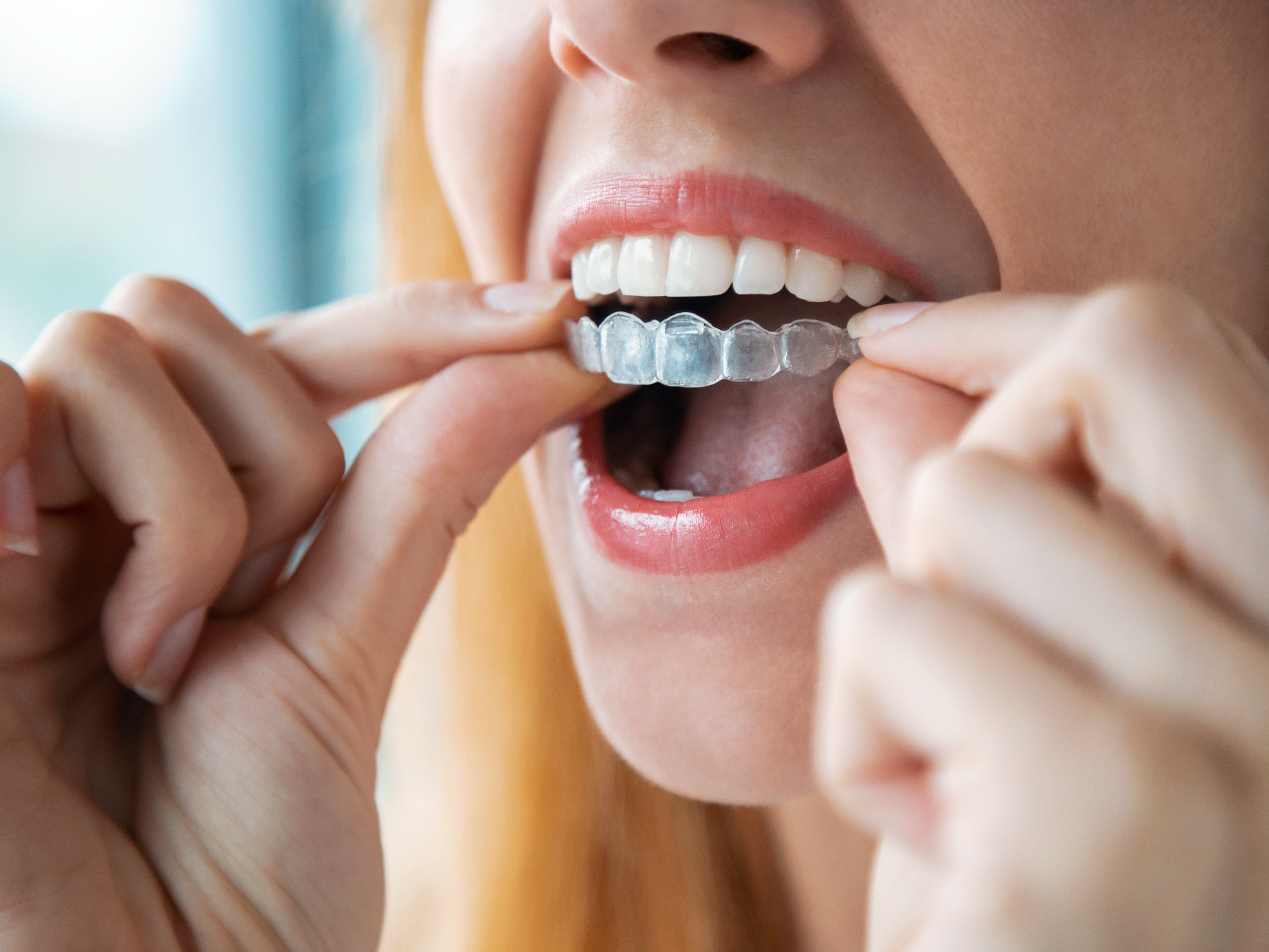 Patient putting in their Invisalign trays 
