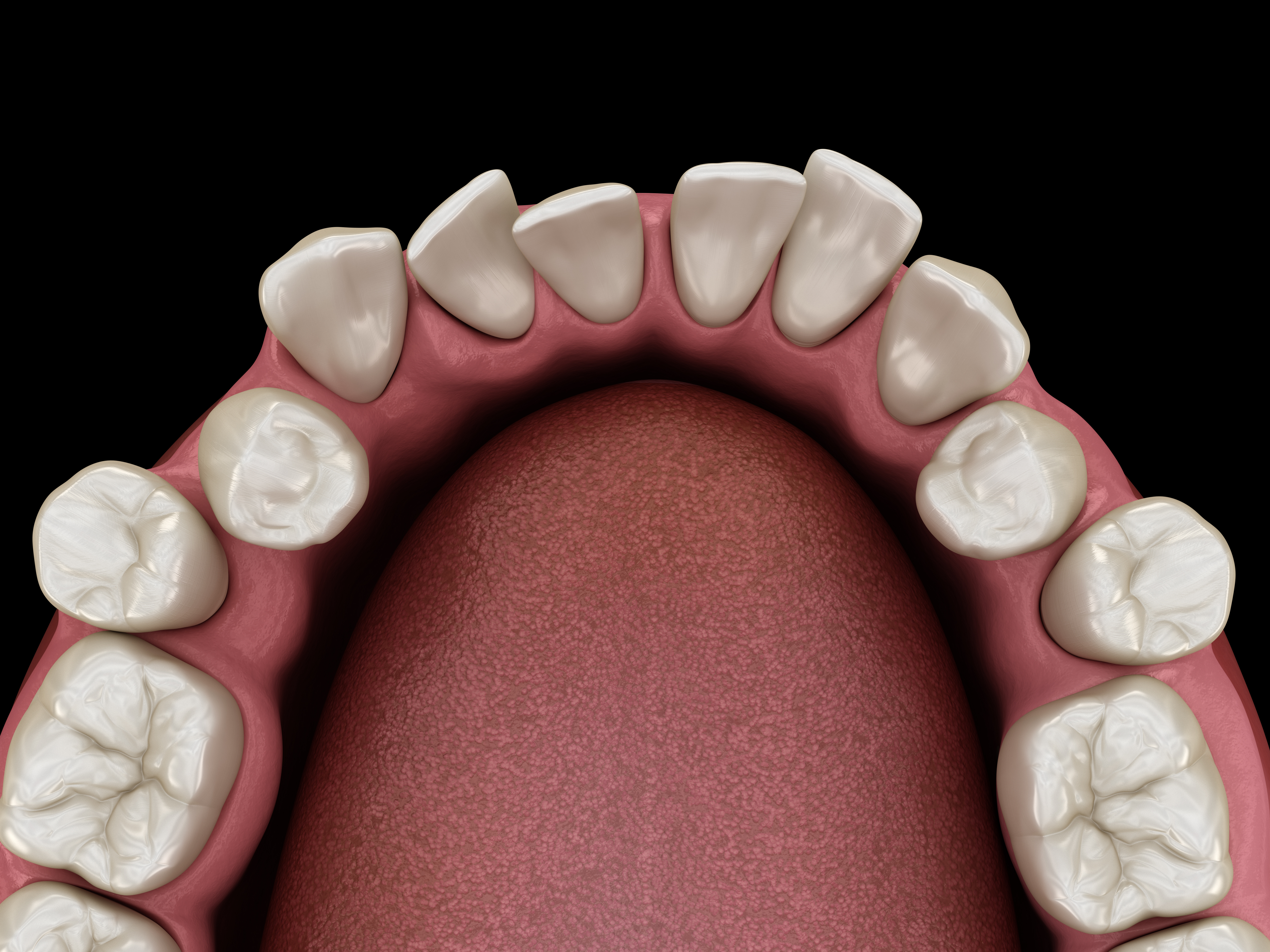 An illustration of crowded teeth before Invisalign treatment 