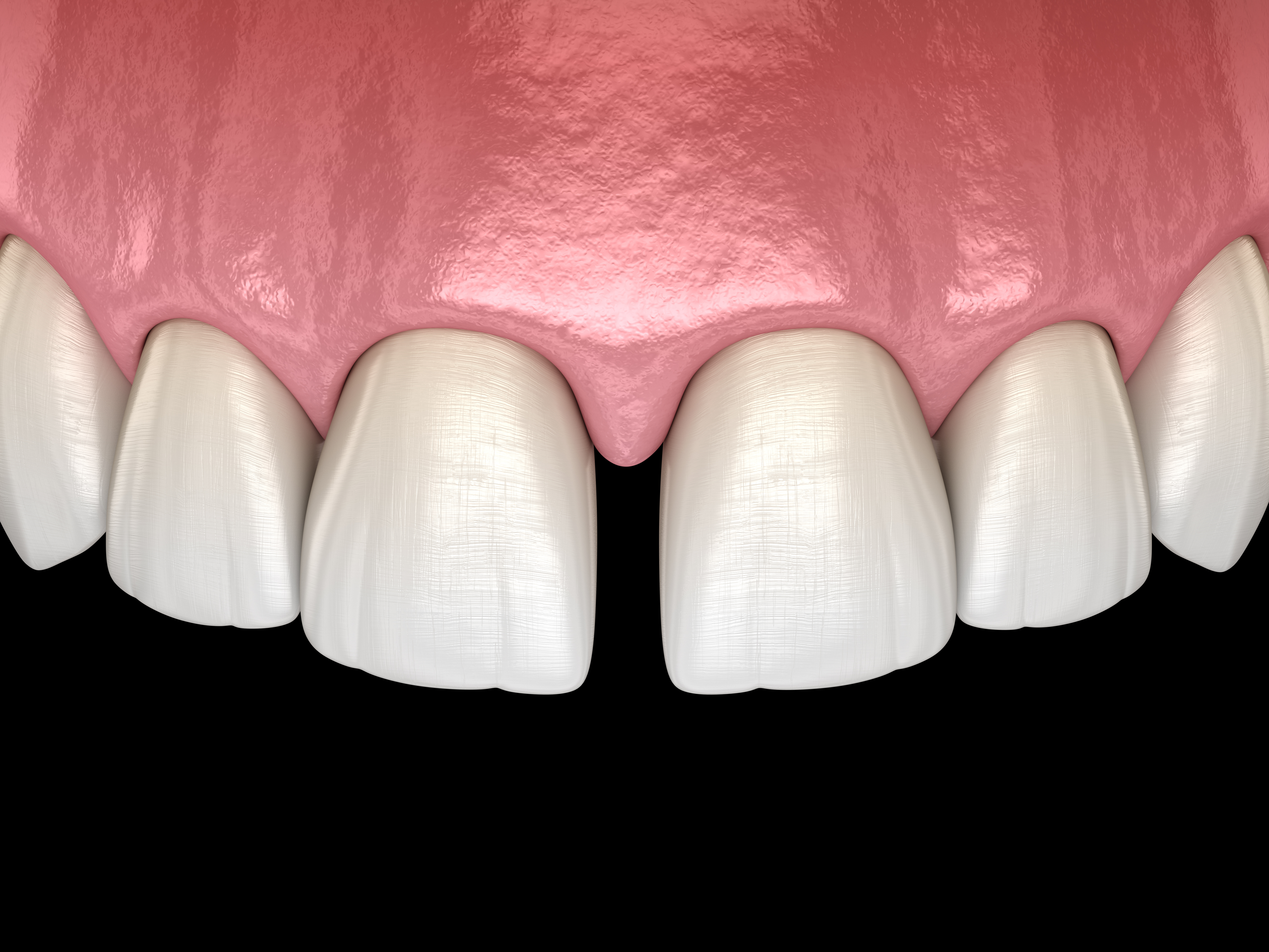 An illustration of gapped teeth before Invisalign treatment 