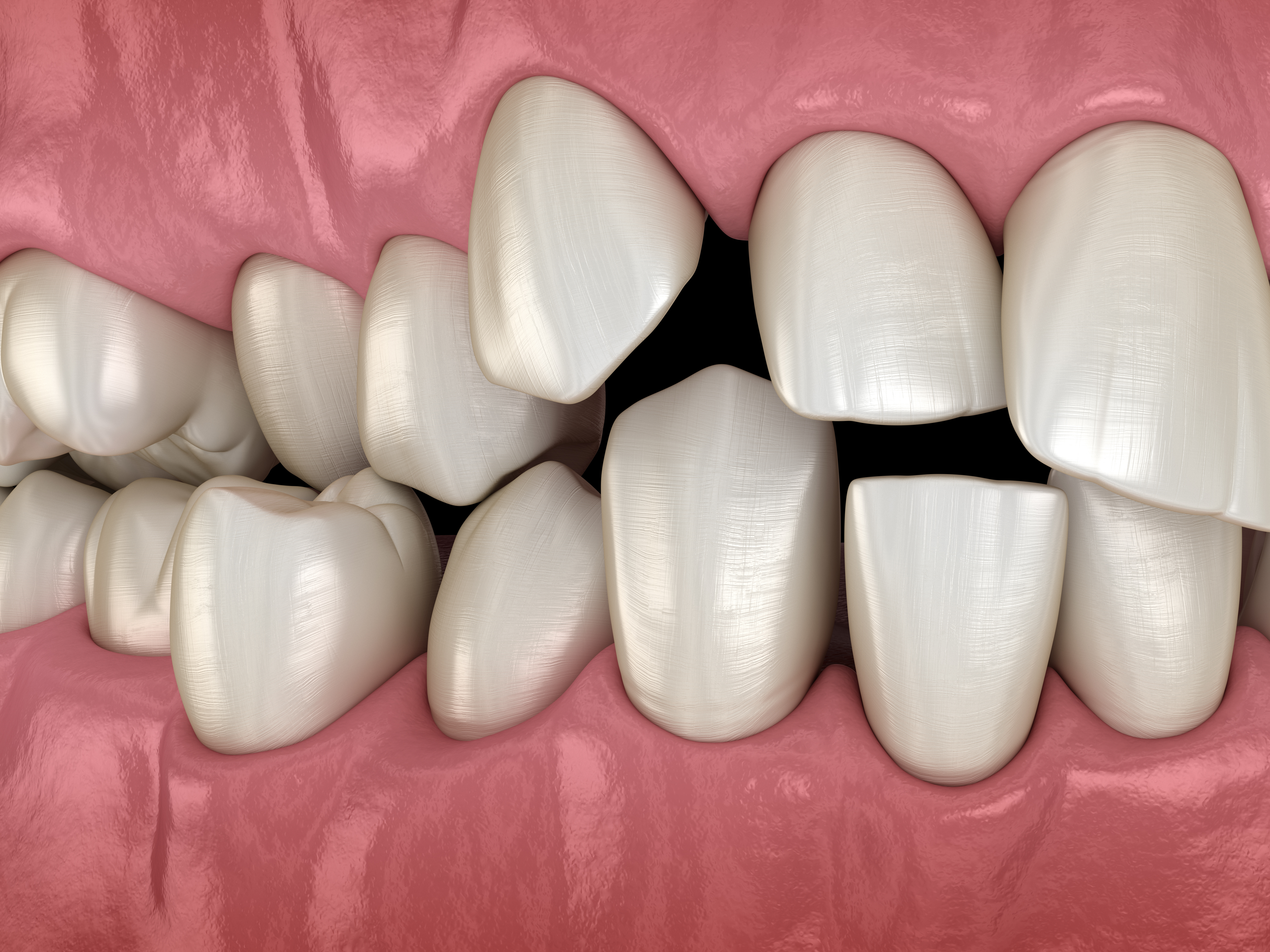 An illustration of gapped teeth before Invisalign treatment 