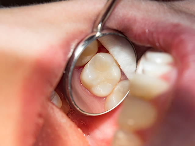 Professional dental cleaning process at Lux Dentistry Alpharetta