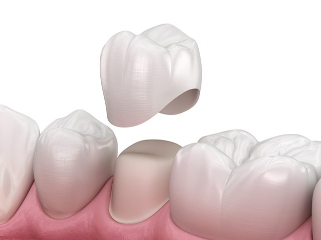 Composite resin filling restoring a cavity to natural appearance