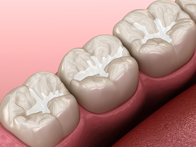 When you need a dental filling at Lux Dentistry Alpharetta