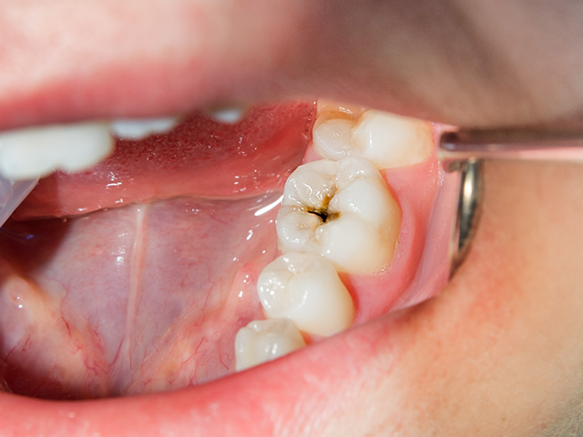 Signs you may need a root canal