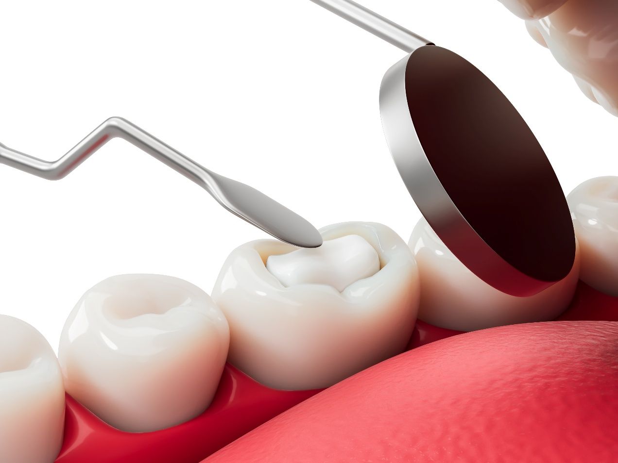 Illustration of tooth-colored filling in Alpharetta being placed