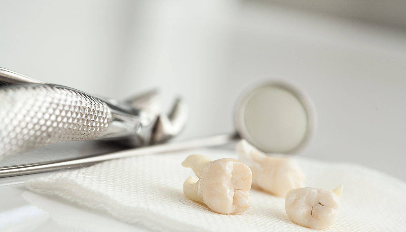 Gentle tooth extraction at Lux Dentistry in Alpharetta, GA
