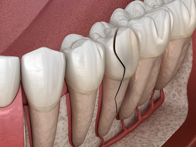 When tooth extraction is necessary
