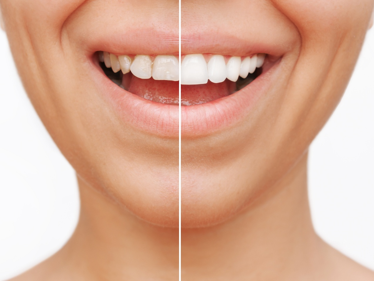 Patient's smile before and after veneers